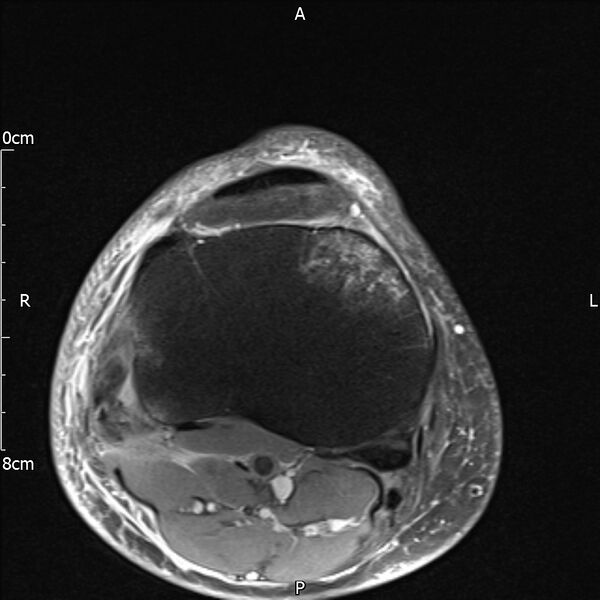 File:Avulsion fracture of the fibular head (Radiopaedia 74804-85808 Axial PD fat sat 27).jpg