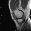 Avulsion fracture of the fibular head (Radiopaedia 74804-85808 D 7).jpg