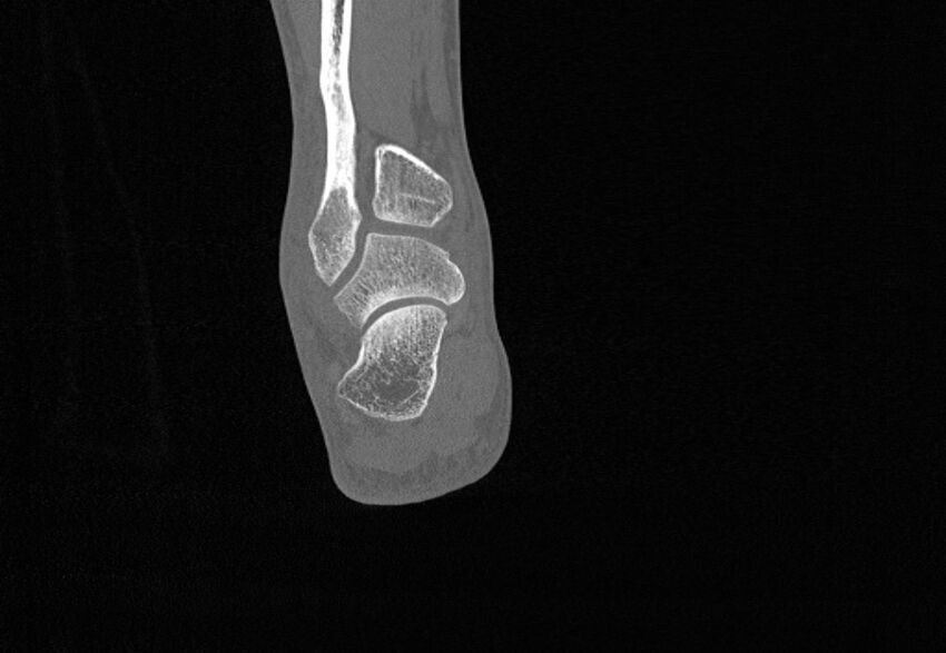 Avulsion fractures of talus and calcaneus (Radiopaedia 48277-53155 Coronal bone window 76).jpg