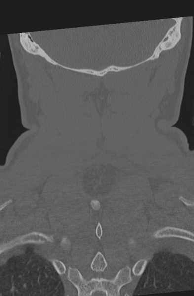 File:Axis peg fracture (type 3) and atlas lateral mass (type 4) fracture (Radiopaedia 37474-39324 Coronal bone window 54).png