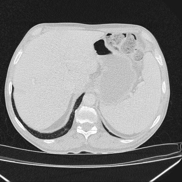 File:Azygos lobe (Radiopaedia 38259-40275 Axial lung window 77).jpg