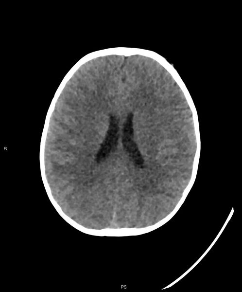 File:Basal ganglia and parenchymal ischemia (Radiopaedia 45818-50083 Axial non-contrast 17).jpg