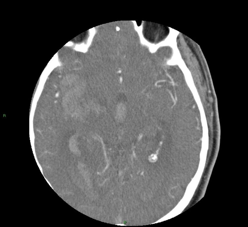 Basal ganglia hemorrhage (Radiopaedia 58763-65985 D 86).jpg