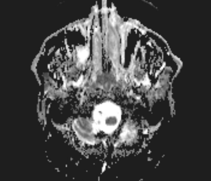 File:Basilar artery dissection (Radiopaedia 77032-88976 Axial ADC 2).jpg