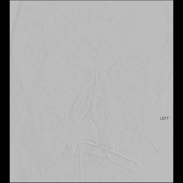 File:Basilar tip thrombus with endovascular clot retrieval (Radiopaedia 46320-50726 D 4).png