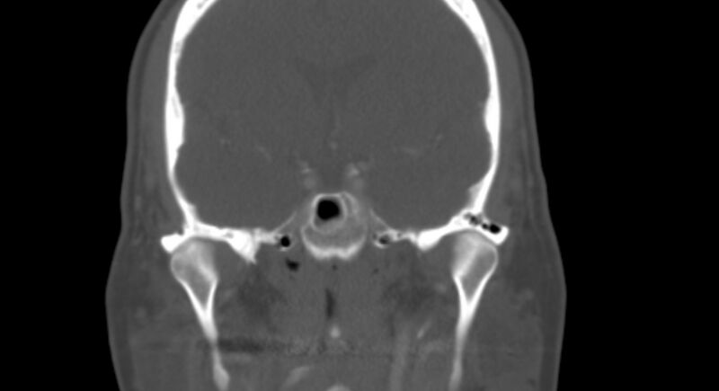 File:Benign mixed salivary tumor of the parotid gland (Radiopaedia 35261-36792 Coronal bone window 16).jpg