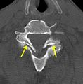 Bilateral C6-7 locked facet dislocation (Radiopaedia 28506-87424 B 1).jpg