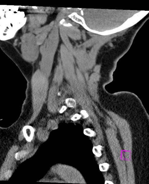 File:Bilateral atlanto-occipital assimilation (Radiopaedia 28350-28603 D 19).jpg
