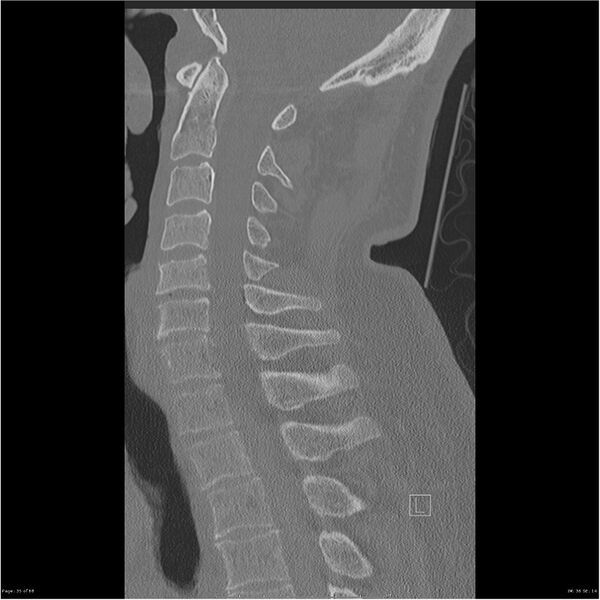 File:Bilateral cervical ribs (Radiopaedia 25868-26017 Sagittal bone window 35).jpg