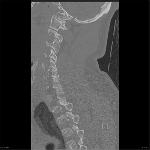File:Bilateral cervical ribs (Radiopaedia 25868-26017 Sagittal bone window 49).jpg