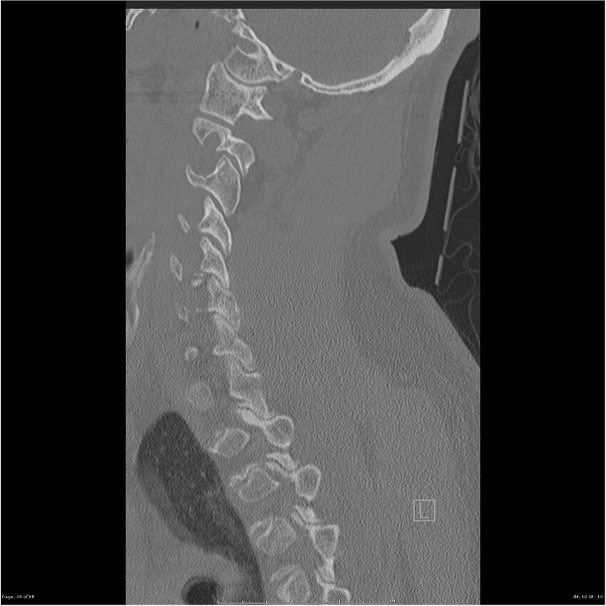 Bilateral cervical ribs (Radiopaedia 25868-26017 Sagittal bone window 49).jpg