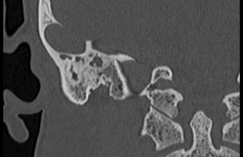 File:Bilateral cholesteatoma (Radiopaedia 54898-61172 Coronal bone window 70).jpg