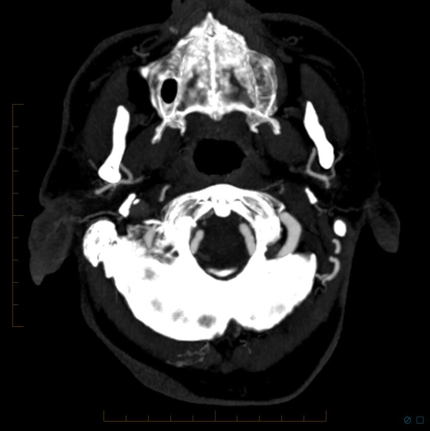 Bilateral chronic common carotid occlusion (Radiopaedia 50849-56362 D 28).jpg