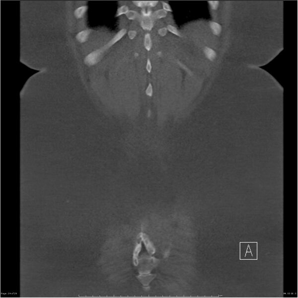 File:Bilateral lumbar ribs (Radiopaedia 25862-26010 Coronal bone window 24).jpg