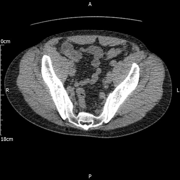 File:Bilateral medullary nephrocalcinosis with ureteric calculi (Radiopaedia 71269-81569 Axial non-contrast 108).jpg