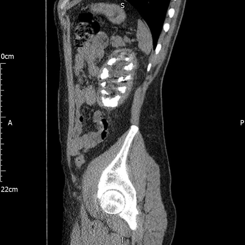 Bilateral medullary nephrocalcinosis with ureteric calculi (Radiopaedia 71269-81569 C 33).jpg