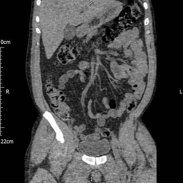 File:Bilateral medullary nephrocalcinosis with ureteric calculi (Radiopaedia 71269-81569 Coronal non-contrast 24).jpg