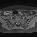 Bilateral ovarian endometriomas (Radiopaedia 87085-103347 Axial T1 fat sat 3).jpg