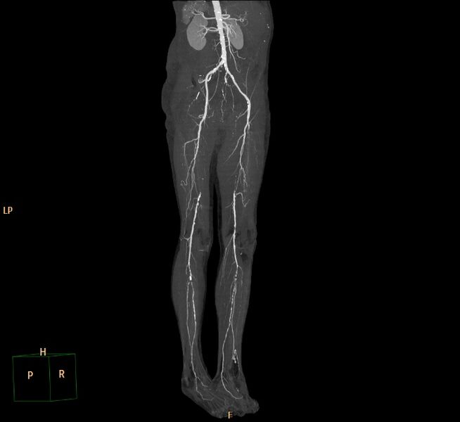 File:Bilateral superficial femoral arterial occlusion (Radiopaedia 25682-25857 3D MIP 11).jpg