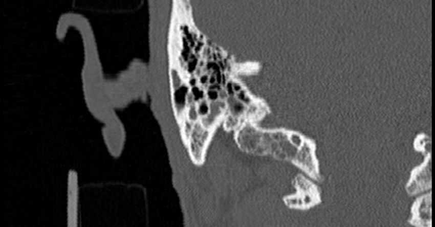 Bilateral temporal bone fractures (Radiopaedia 29482-29970 Coronal non-contrast 156).jpg