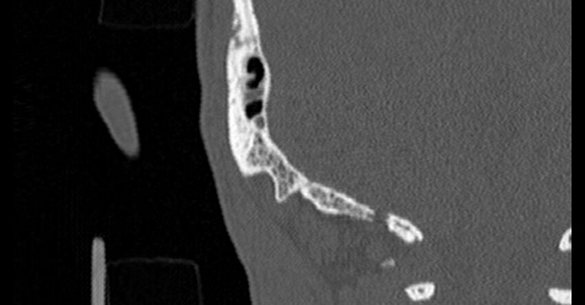 Bilateral temporal bone fractures (Radiopaedia 29482-29970 Coronal non-contrast 187).jpg
