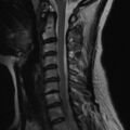 Bilateral tortuous vertebral arteries (Radiopaedia 19070-19039 Sagittal T2 4).jpg