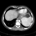 Biliary necrosis - liver transplant (Radiopaedia 21876-21846 B 7).jpg