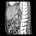 Biliary necrosis - liver transplant (Radiopaedia 21876-21846 D 3).jpg