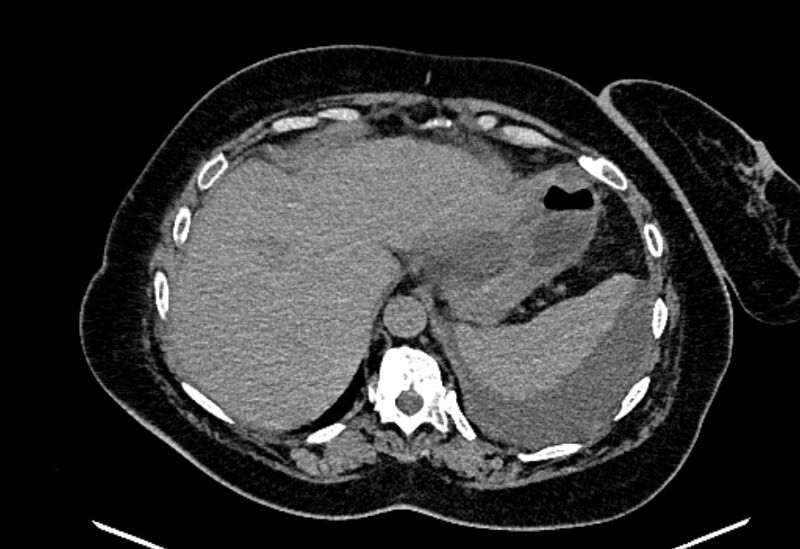 File:Biliary pancreatitis (Radiopaedia 72289-82823 Axial non-contrast 60).jpg