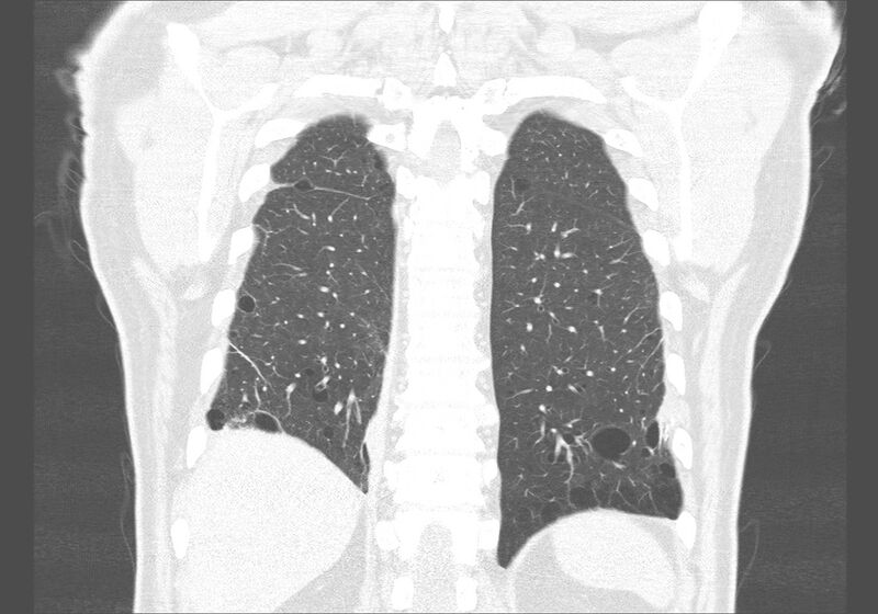 File:Birt-Hogg-Dubé syndrome (Radiopaedia 52578-58491 Coronal lung window 51).jpg