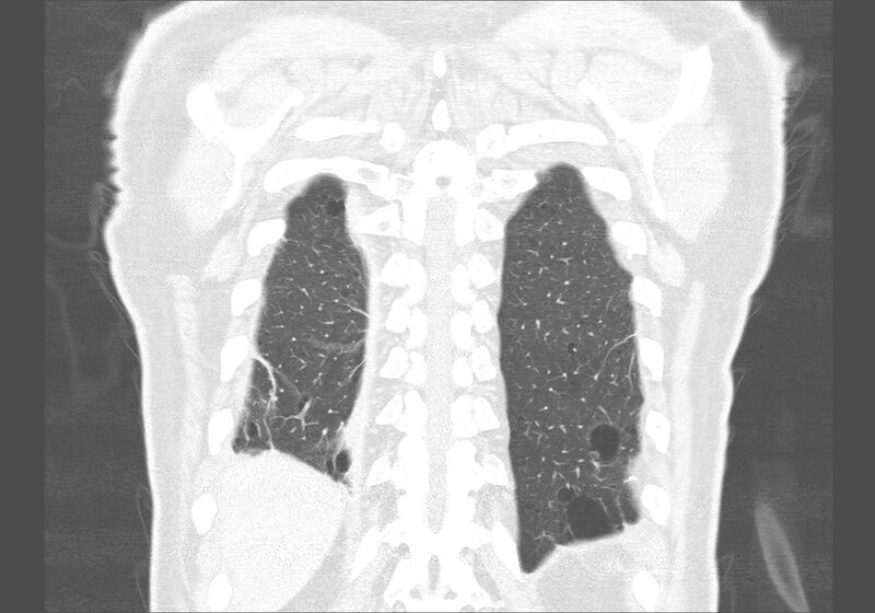 File:Birt-Hogg-Dubé syndrome (Radiopaedia 52578-58491 Coronal lung window 56).jpg