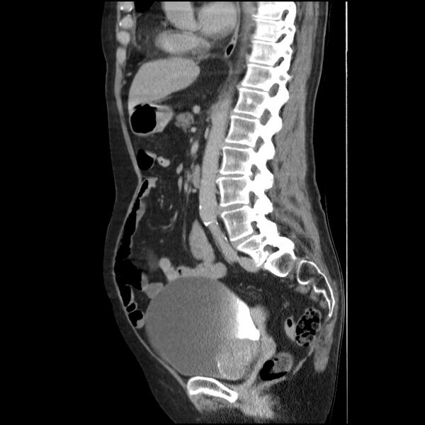 File:Bladder tumor detected on trauma CT (Radiopaedia 51809-57609 E 34).jpg