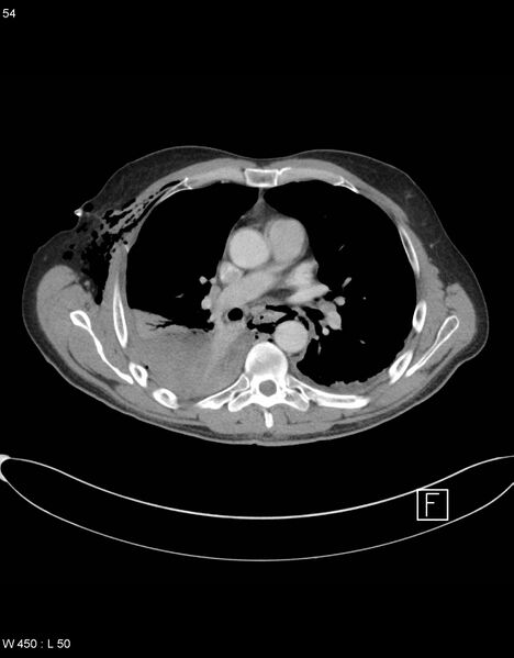 File:Boerhaave syndrome with tension pneumothorax (Radiopaedia 56794-63605 A 26).jpg