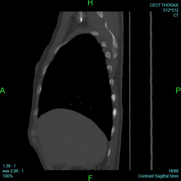 File:Bone metastases from lung carcinoma (Radiopaedia 54703-60937 Sagittal bone window 16).jpg