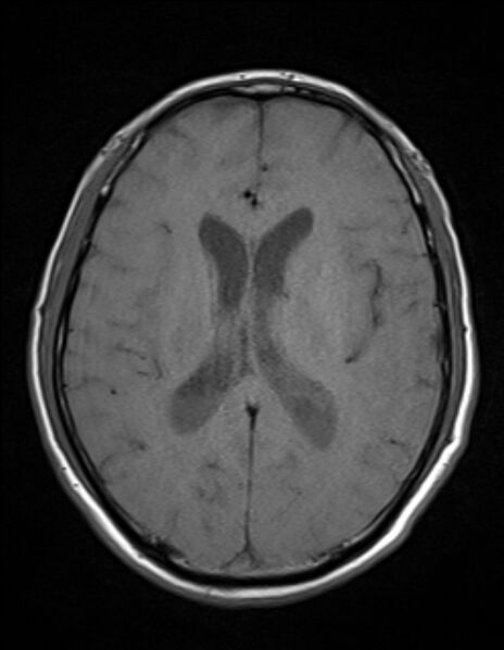 File:Brain abscess with ventriculitis (Radiopaedia 85703-101495 Axial T1 16).jpg