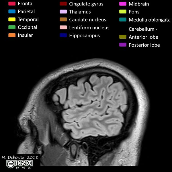 File:Brain lobes - annotated MRI (Radiopaedia 61691-69700 Sagittal 6).JPG