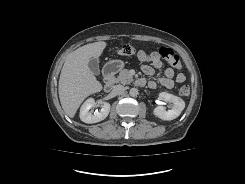 File:Brain metastases from renal cell carcinoma (Radiopaedia 42222-45328 Axial C+ delayed 81).jpg