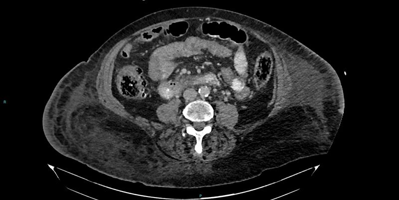 File:Breast cancer pelvic bony metastases (Radiopaedia 84470-99824 Axial bone window 10).jpg