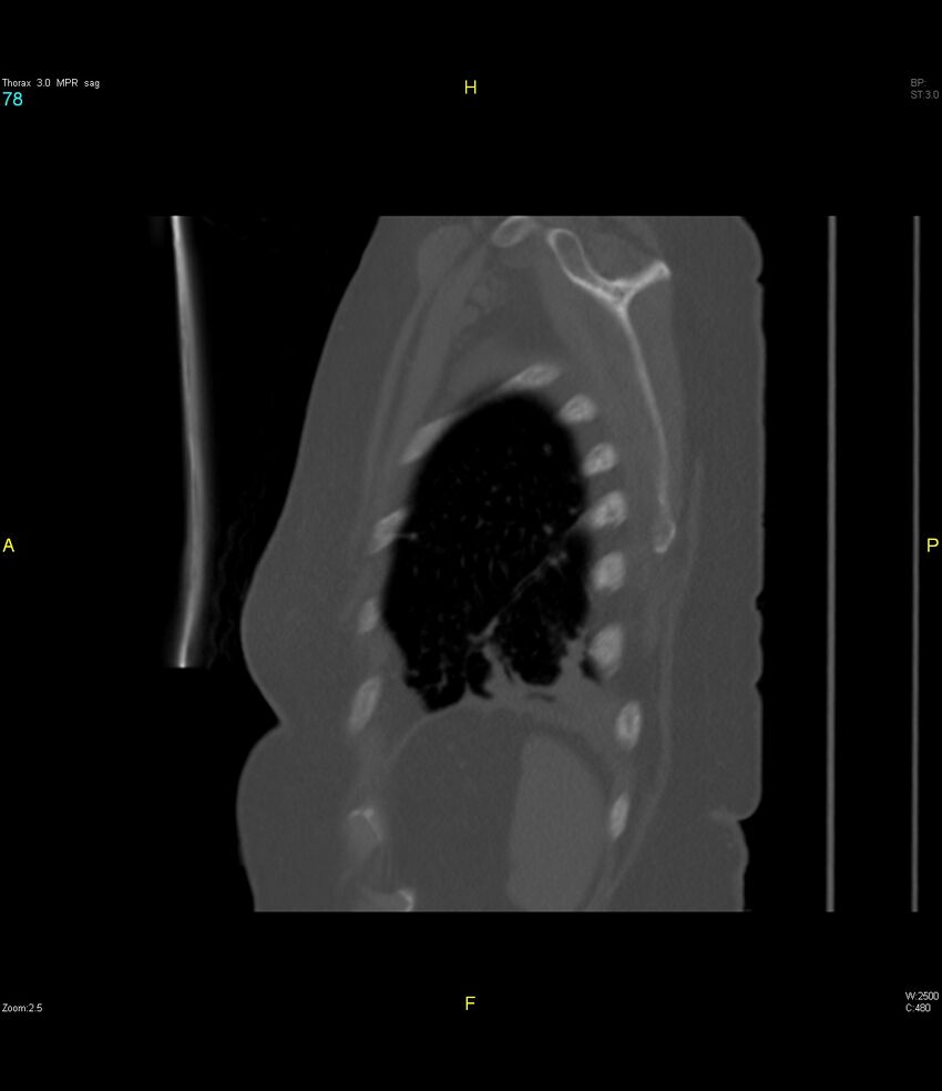 Breast primary with lung and bone metastases (Radiopaedia 40620-43228 Sagittal bone window 78).jpg