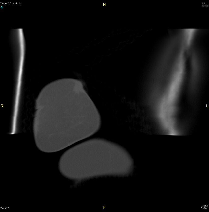 Breast primary with lung and bone metastases (Radiopaedia 40620-43228 bone window 4).jpg