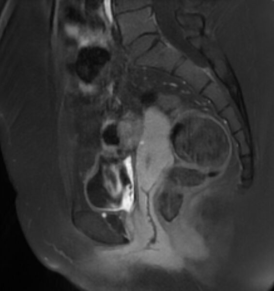File:Broad ligament leiomyoma (Radiopaedia 81634-95516 G 15).jpg