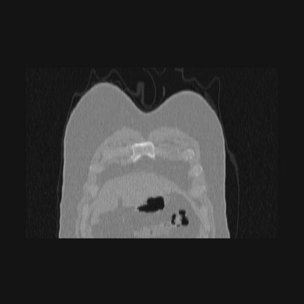 File:Bronchial atresia (Radiopaedia 60685-68439 Coronal lung window 75).jpg