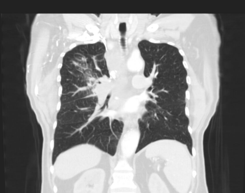 Bronchogenic carcinoma with lymphangitic spread (Radiopaedia 29002-29357 Coronal lung window 39).jpg