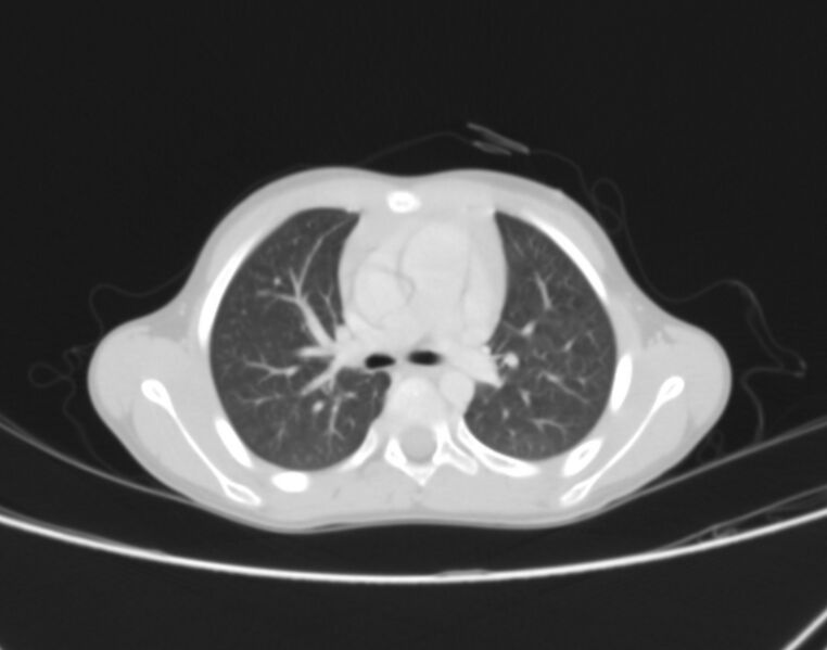 File:Bronchus suis (Radiopaedia 68131-77620 Axial lung window 30).jpg
