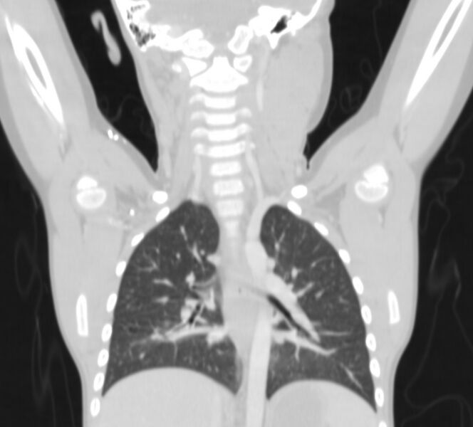 File:Bronchus suis (Radiopaedia 68131-77620 Coronal lung window 20).jpg