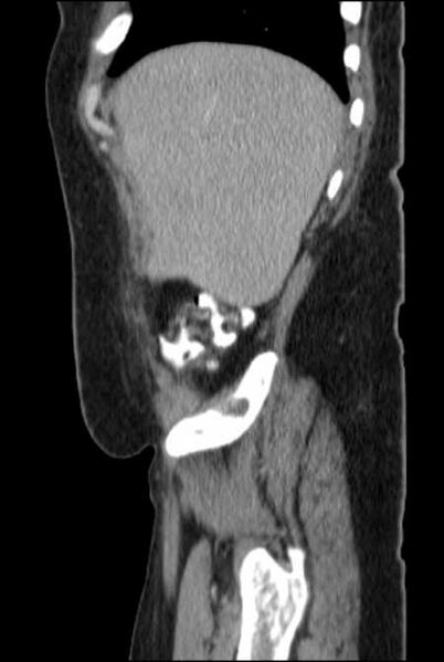 File:Brown tumors compressing the spinal cord (Radiopaedia 68442-77988 F 11).jpg