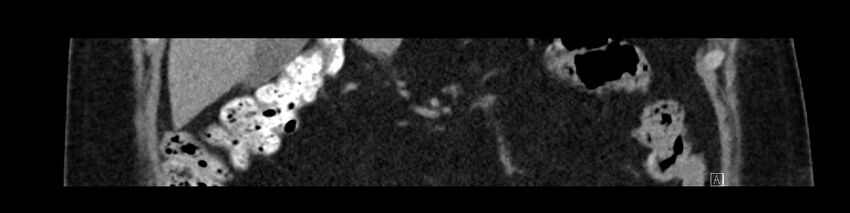 Buried bumper syndrome - gastrostomy tube (Radiopaedia 63843-72575 Coronal Inject 36).jpg