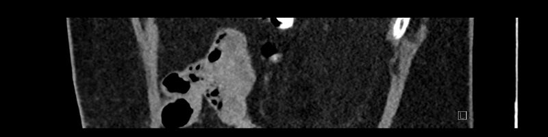 File:Buried bumper syndrome - gastrostomy tube (Radiopaedia 63843-72575 Sagittal Inject 20).jpg