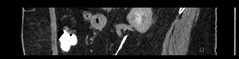 File:Buried bumper syndrome - gastrostomy tube (Radiopaedia 63843-72575 Sagittal Inject 41).jpg