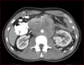 Burned-out testicular choriocarcinoma (Radiopaedia 32822-34040 B 8).PNG